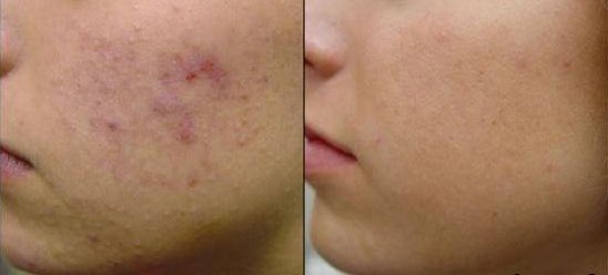 Before and after comparison of acne on a person's face.